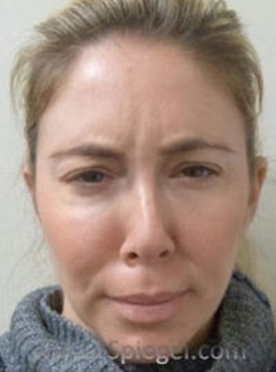Botox / Dysport / Jeuveau / Xeomin Before & After Gallery - Patient 412862 - Image 1
