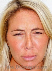 Botox / Dysport / Jeuveau / Xeomin Before & After Gallery - Patient 412862 - Image 2