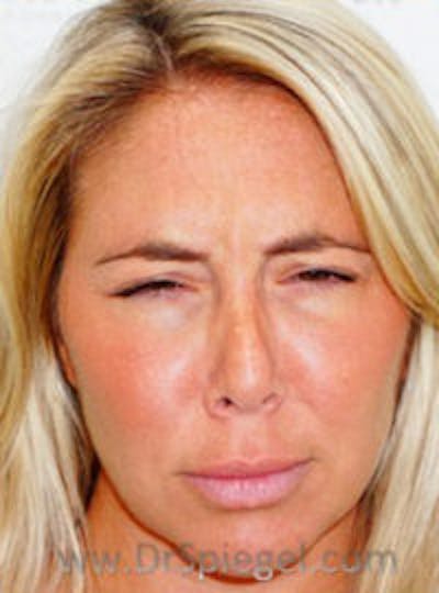 Botox / Dysport / Jeuveau / Xeomin Before & After Gallery - Patient 412862 - Image 2