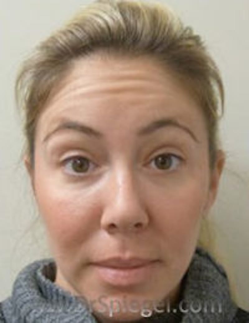 Botox / Dysport / Jeuveau / Xeomin Before & After Gallery - Patient 412862 - Image 3