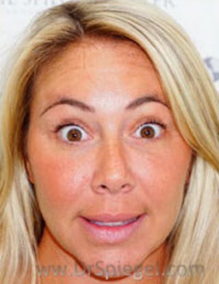 Botox / Dysport / Jeuveau / Xeomin Before & After Gallery - Patient 412862 - Image 4