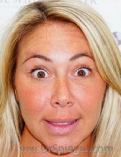 Botox / Dysport / Jeuveau / Xeomin Before & After Gallery - Patient 412862 - Image 4
