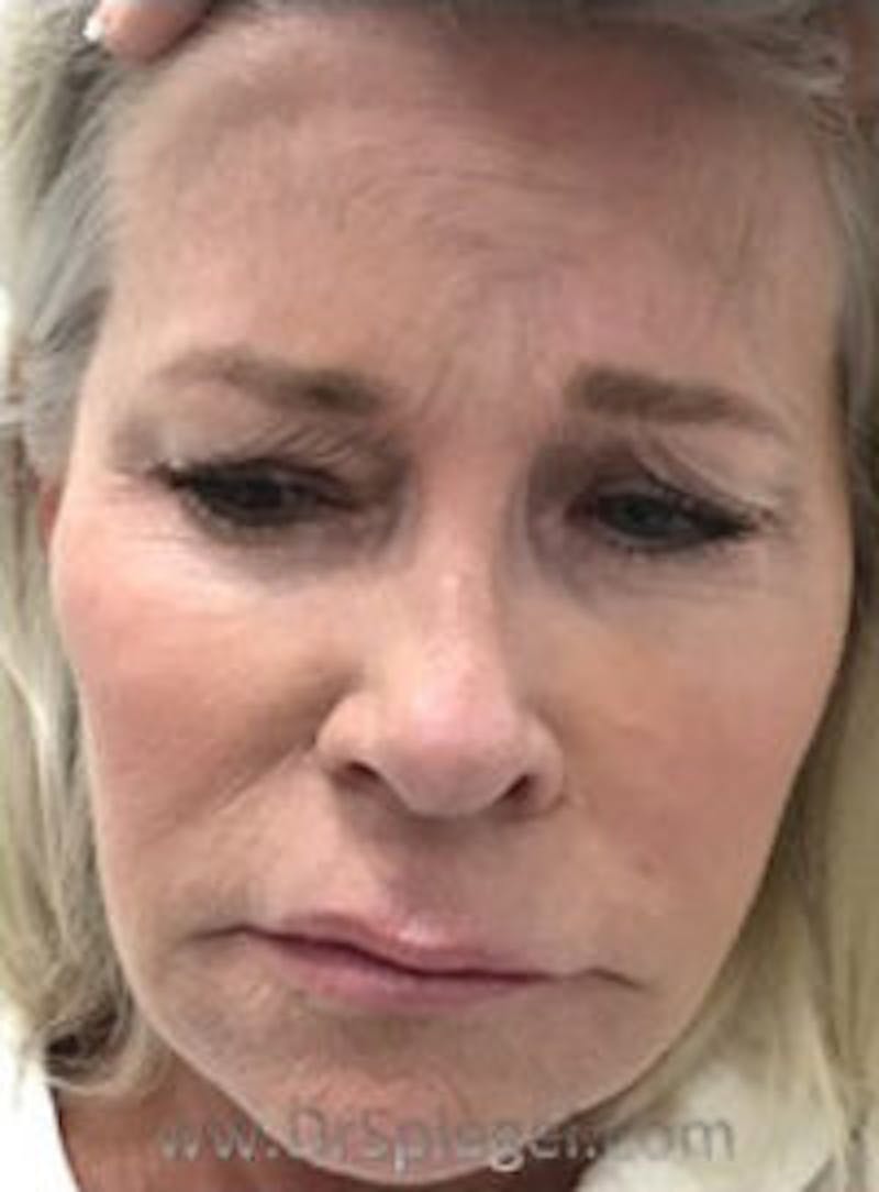 Botox / Dysport / Jeuveau / Xeomin Before & After Gallery - Patient 318603 - Image 1