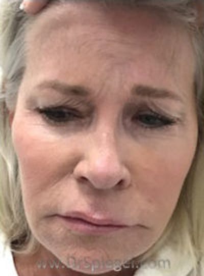 Botox / Dysport / Jeuveau / Xeomin Before & After Gallery - Patient 318603 - Image 1