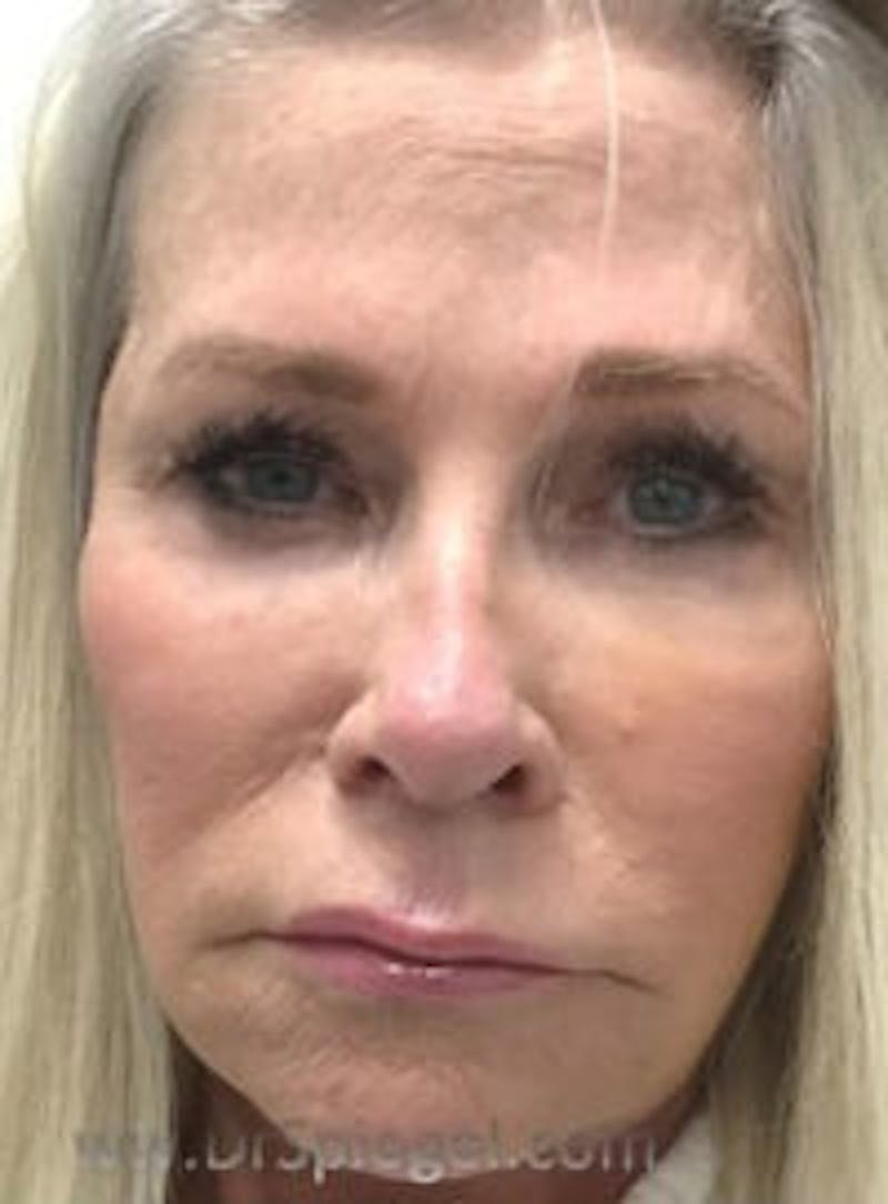 Botox / Dysport / Jeuveau / Xeomin Before & After Gallery - Patient 318603 - Image 2