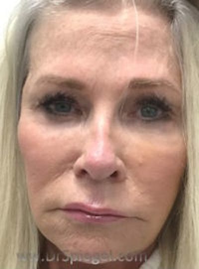 Botox / Dysport / Jeuveau / Xeomin Before & After Gallery - Patient 318603 - Image 2