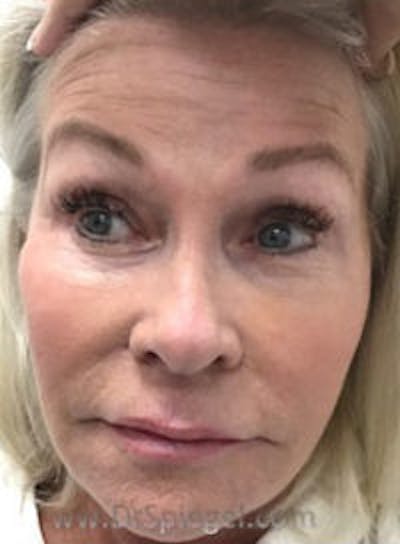 Botox / Dysport / Jeuveau / Xeomin Before & After Gallery - Patient 318603 - Image 3