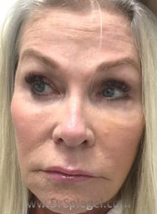 Botox / Dysport / Jeuveau / Xeomin Before & After Gallery - Patient 318603 - Image 4