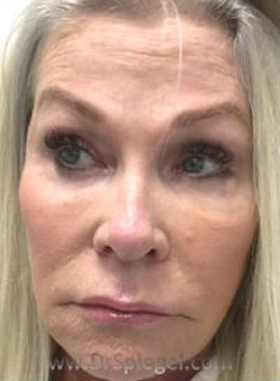 Botox / Dysport / Jeuveau / Xeomin Before & After Gallery - Patient 318603 - Image 4