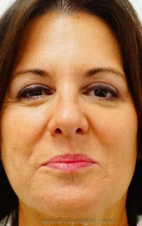 Botox / Dysport / Jeuveau / Xeomin Before & After Gallery - Patient 256728 - Image 2