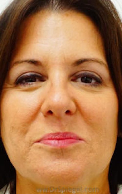 Botox / Dysport / Jeuveau / Xeomin Before & After Gallery - Patient 256728 - Image 2