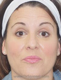Botox / Dysport / Jeuveau / Xeomin Before & After Gallery - Patient 256728 - Image 3