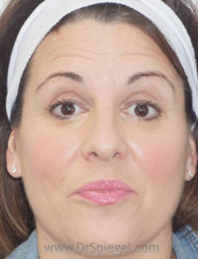 Botox / Dysport / Jeuveau / Xeomin Before & After Gallery - Patient 256728 - Image 3