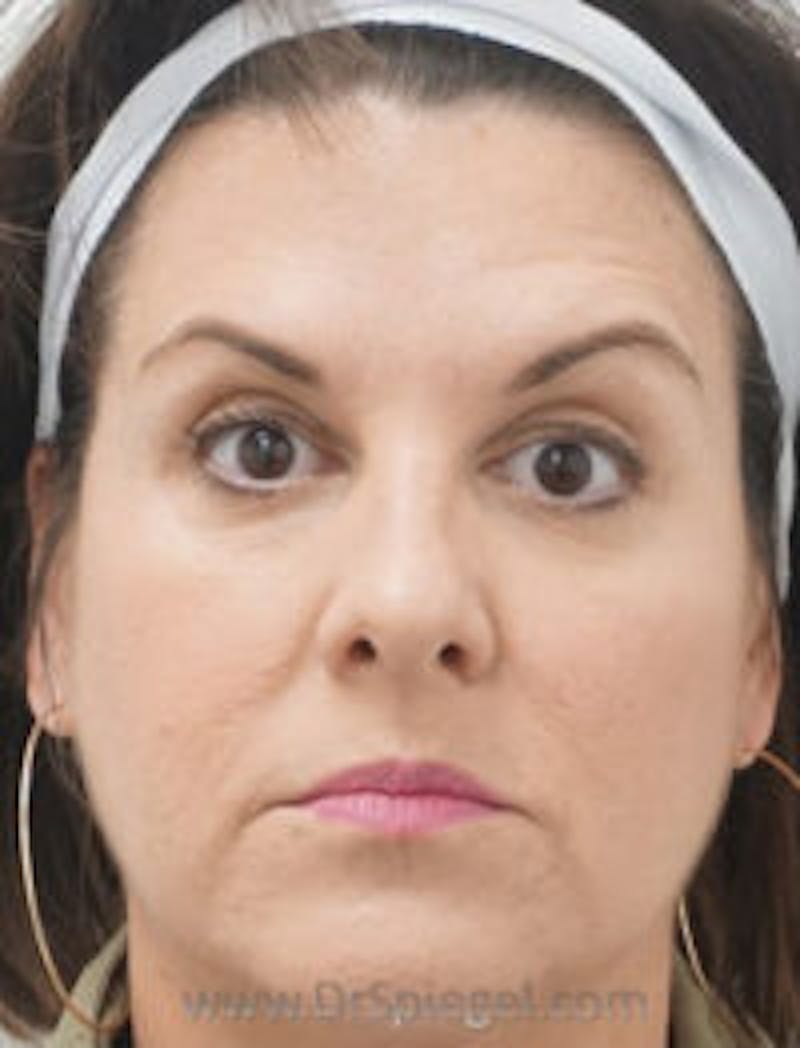 Botox / Dysport / Jeuveau / Xeomin Before & After Gallery - Patient 256728 - Image 4