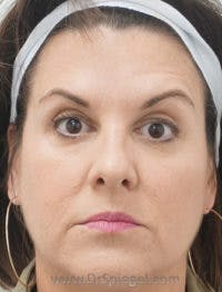 Botox / Dysport / Jeuveau / Xeomin Before & After Gallery - Patient 256728 - Image 4