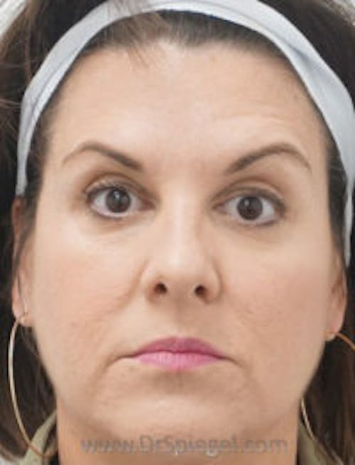 Botox / Dysport / Jeuveau / Xeomin Before & After Gallery - Patient 256728 - Image 4