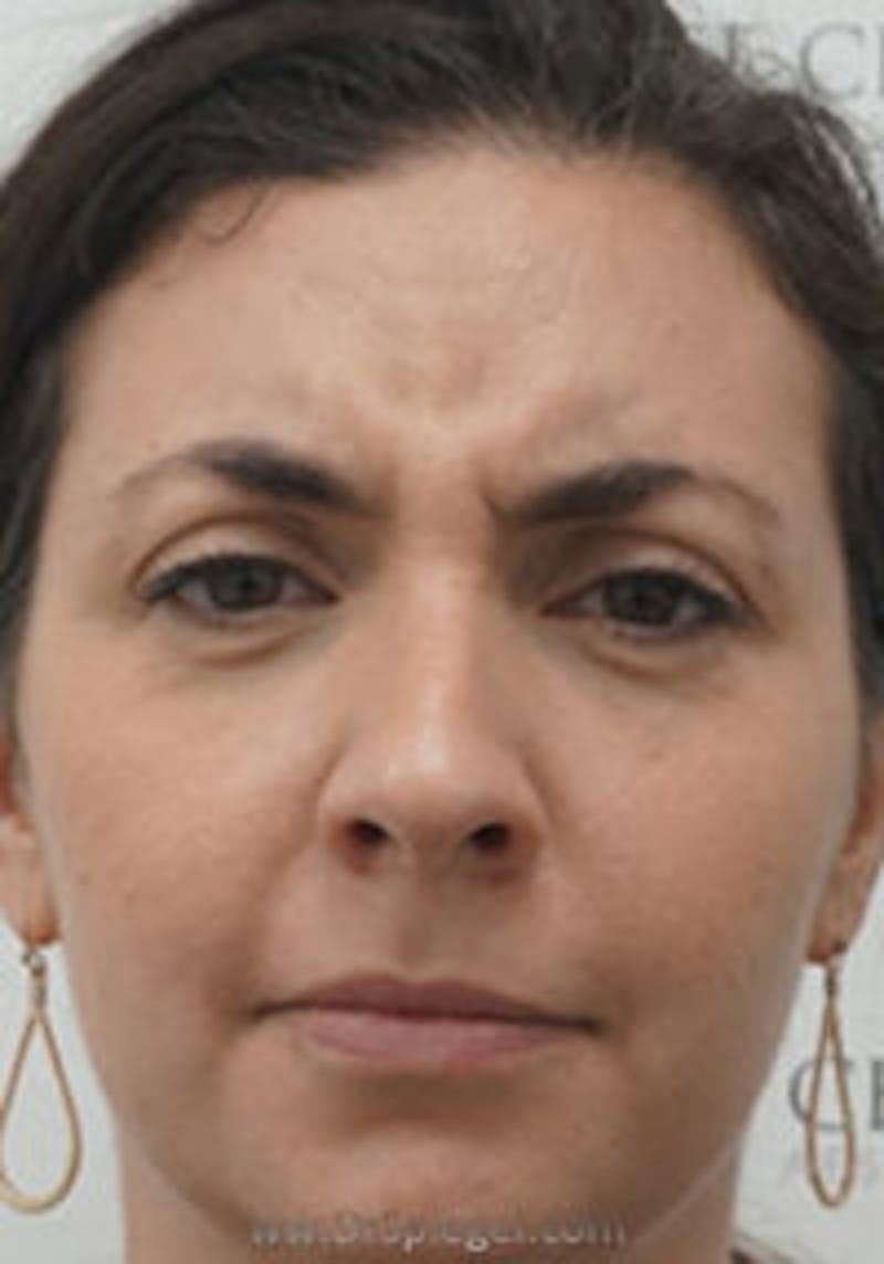 Botox / Dysport / Jeuveau / Xeomin Before & After Gallery - Patient 131638 - Image 1