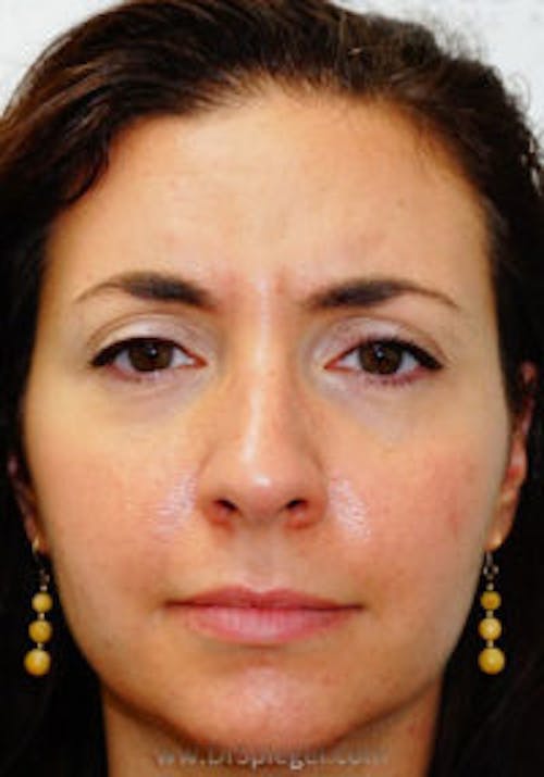 Botox / Dysport / Jeuveau / Xeomin Before & After Gallery - Patient 131638 - Image 2