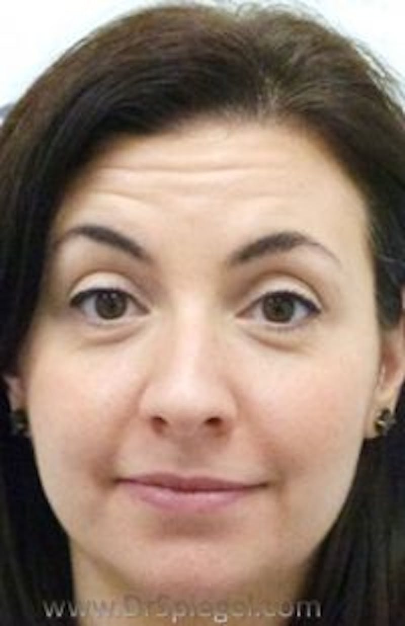 Botox / Dysport / Jeuveau / Xeomin Before & After Gallery - Patient 131638 - Image 3