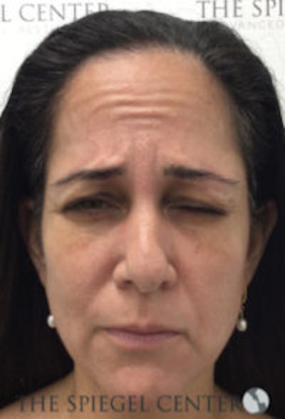 Botox / Dysport / Jeuveau / Xeomin Before & After Gallery - Patient 281840 - Image 1