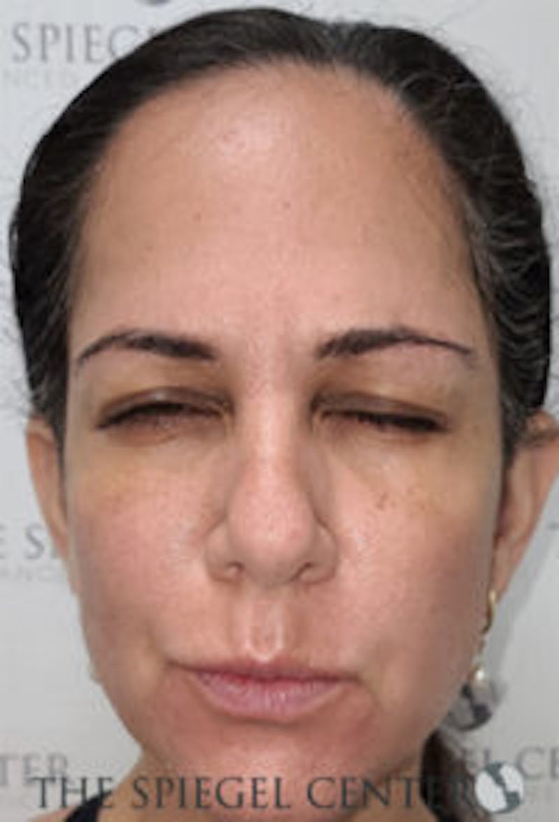Botox / Dysport / Jeuveau / Xeomin Before & After Gallery - Patient 281840 - Image 2