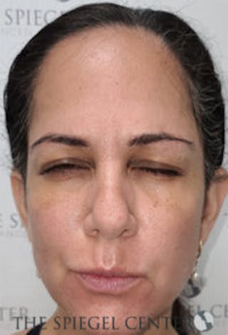 Botox / Dysport / Jeuveau / Xeomin Before & After Gallery - Patient 281840 - Image 2