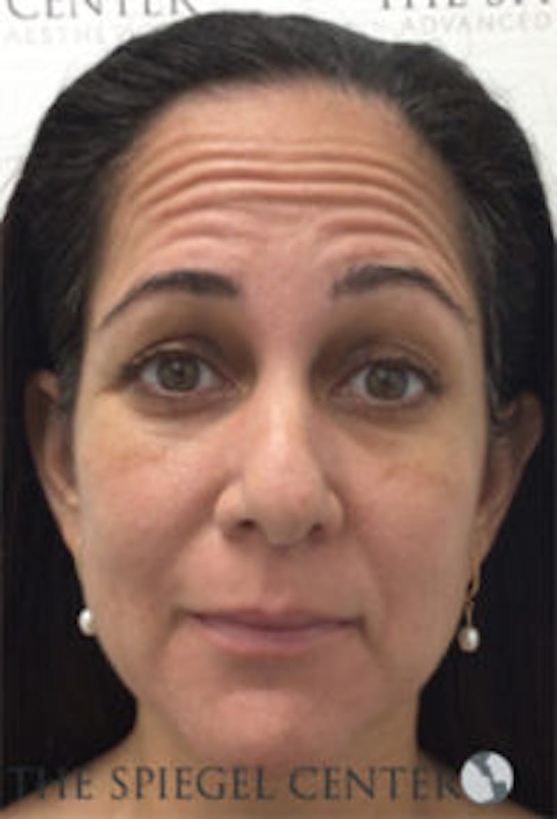 Botox / Dysport / Jeuveau / Xeomin Before & After Gallery - Patient 281840 - Image 3