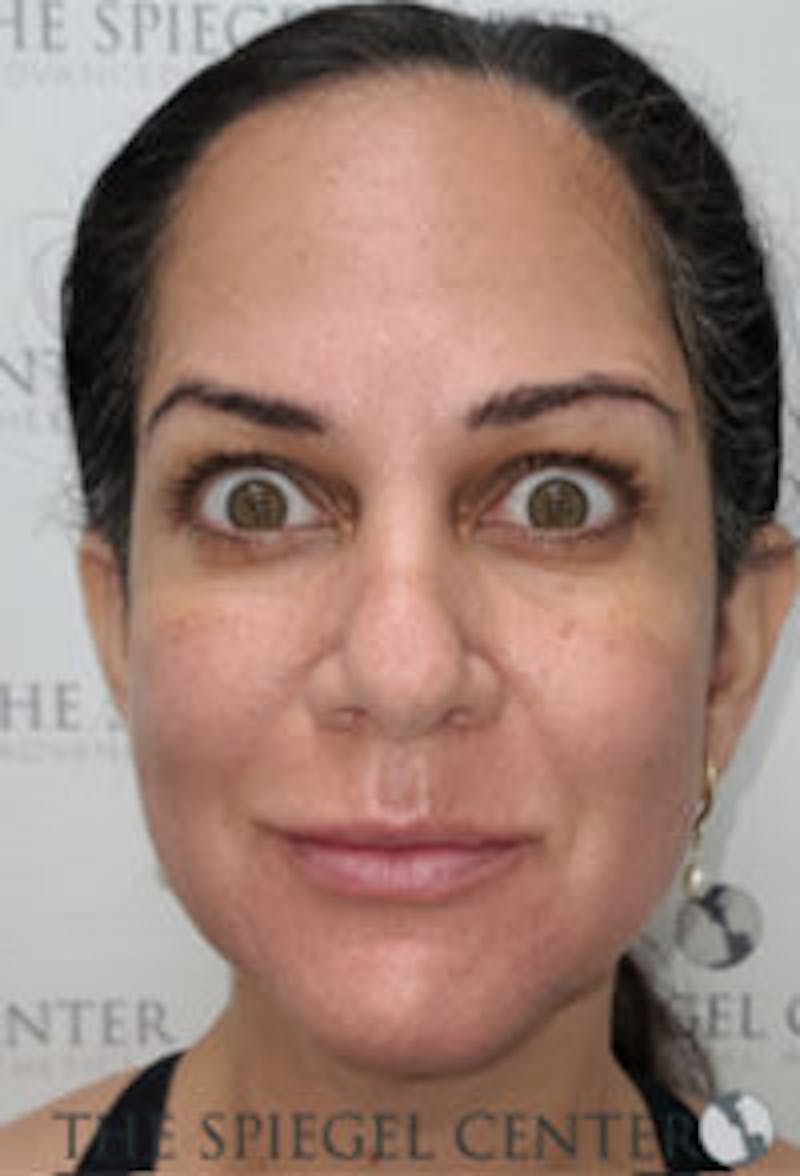 Botox / Dysport / Jeuveau / Xeomin Before & After Gallery - Patient 281840 - Image 4