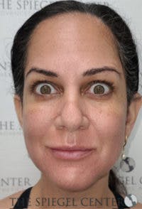 Botox / Dysport / Jeuveau / Xeomin Before & After Gallery - Patient 281840 - Image 4