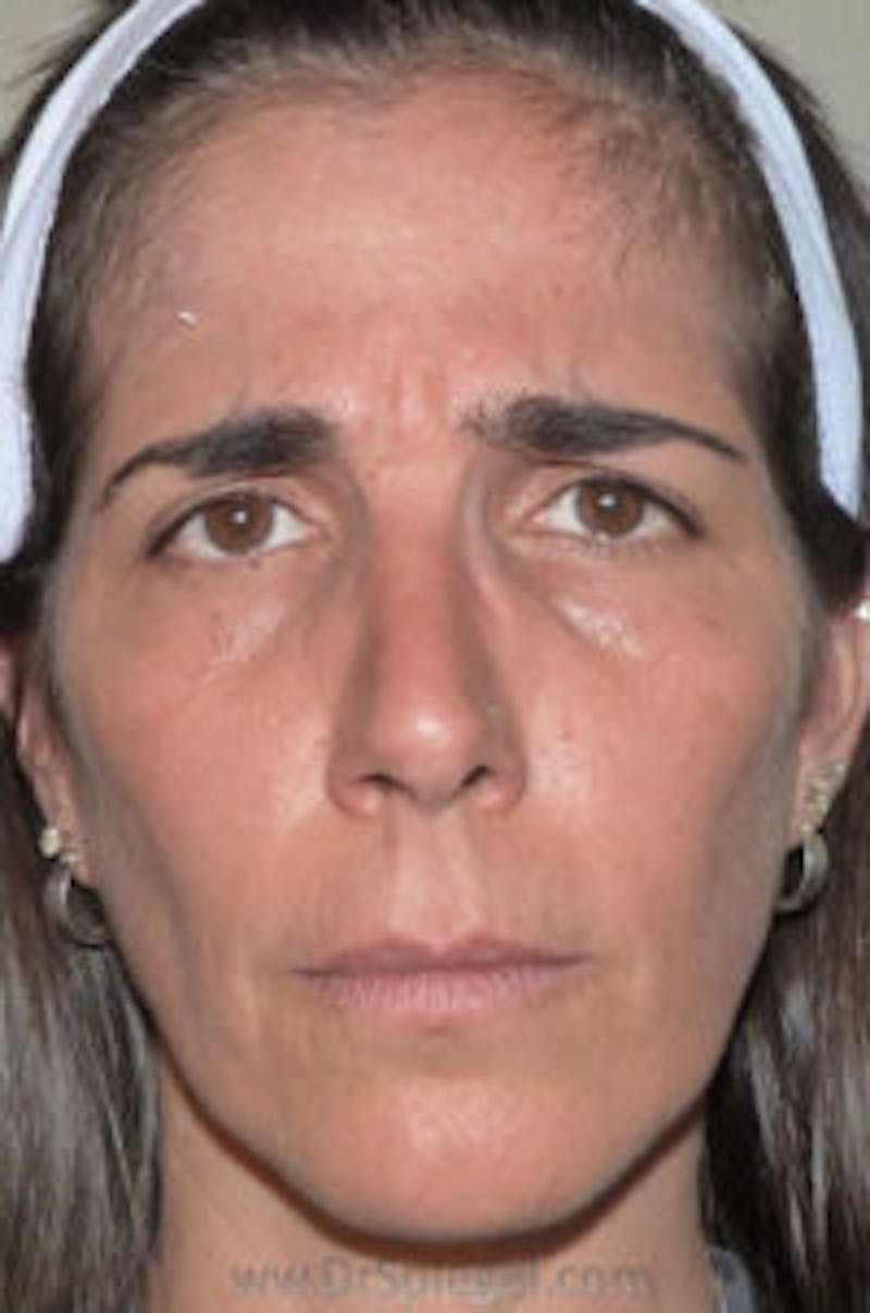 Botox / Dysport / Jeuveau / Xeomin Before & After Gallery - Patient 324493 - Image 1