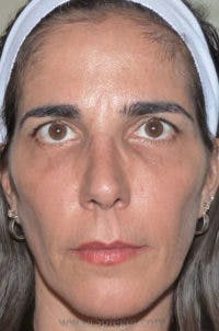 Botox / Dysport / Jeuveau / Xeomin Before & After Gallery - Patient 324493 - Image 2