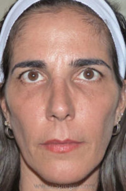 Botox / Dysport / Jeuveau / Xeomin Before & After Gallery - Patient 324493 - Image 2