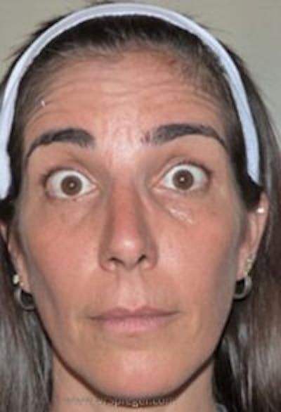 Botox / Dysport / Jeuveau / Xeomin Before & After Gallery - Patient 324493 - Image 3