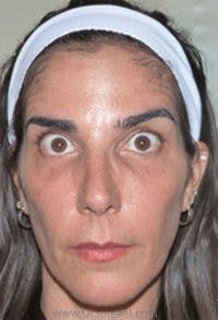 Botox / Dysport / Jeuveau / Xeomin Before & After Gallery - Patient 324493 - Image 4
