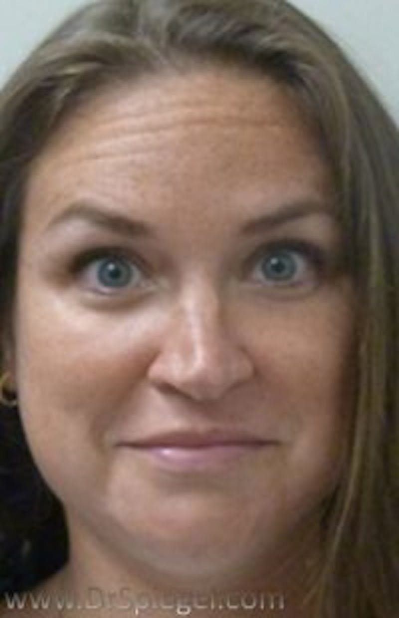 Botox / Dysport / Jeuveau / Xeomin Before & After Gallery - Patient 238529 - Image 3