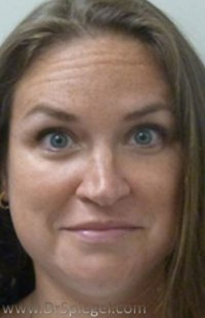 Botox / Dysport / Jeuveau / Xeomin Before & After Gallery - Patient 238529 - Image 3