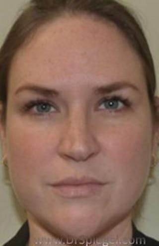 Botox / Dysport / Jeuveau / Xeomin Before & After Gallery - Patient 238529 - Image 4