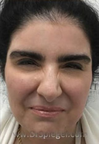 Botox / Dysport / Jeuveau / Xeomin Before & After Gallery - Patient 308408 - Image 2