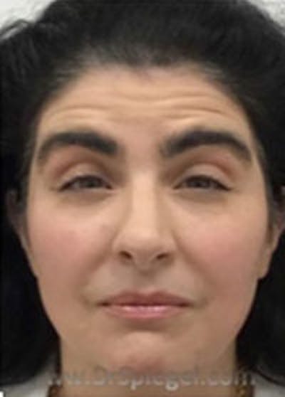 Botox / Dysport / Jeuveau / Xeomin Before & After Gallery - Patient 308408 - Image 3