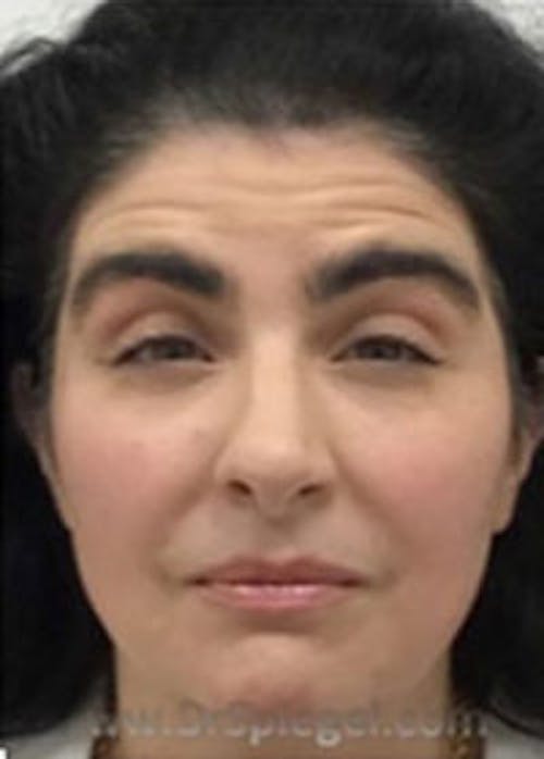Botox / Dysport / Jeuveau / Xeomin Before & After Gallery - Patient 308408 - Image 3