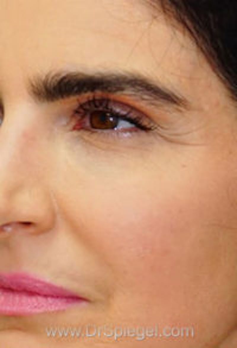 Botox / Dysport / Jeuveau / Xeomin Before & After Gallery - Patient 308408 - Image 5