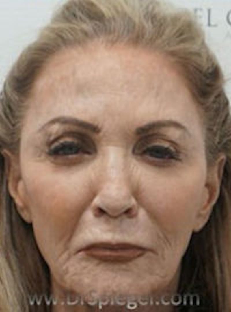 Botox / Dysport / Jeuveau / Xeomin Before & After Gallery - Patient 356372 - Image 2