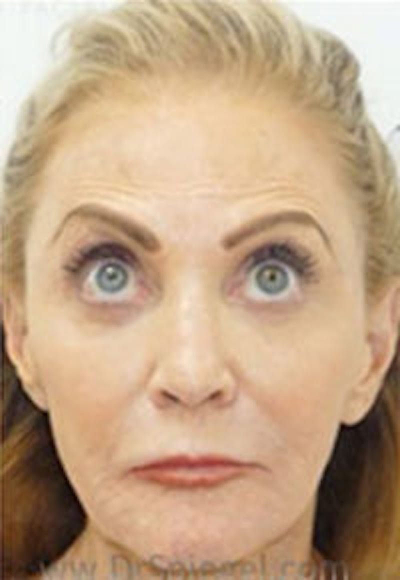 Botox / Dysport / Jeuveau / Xeomin Before & After Gallery - Patient 356372 - Image 3