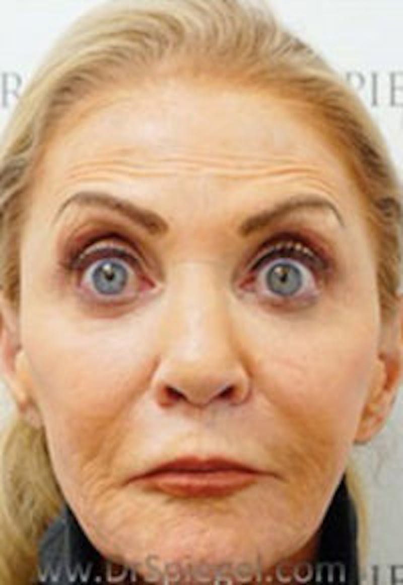 Botox / Dysport / Jeuveau / Xeomin Before & After Gallery - Patient 356372 - Image 4