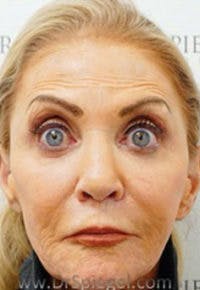 Botox / Dysport / Jeuveau / Xeomin Before & After Gallery - Patient 356372 - Image 4