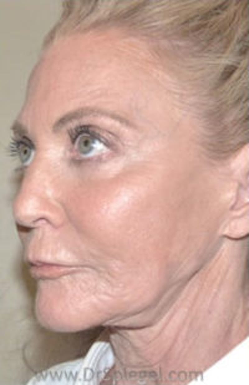 Botox / Dysport / Jeuveau / Xeomin Before & After Gallery - Patient 356372 - Image 5