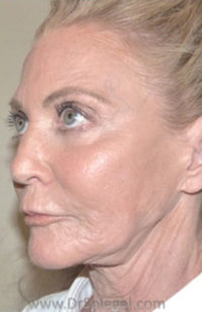 Botox / Dysport / Jeuveau / Xeomin Before & After Gallery - Patient 356372 - Image 5