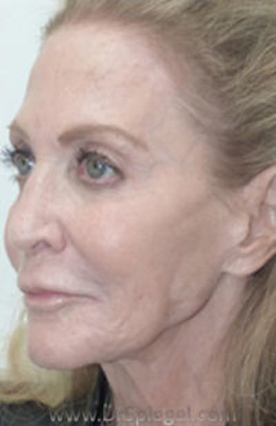 Botox / Dysport / Jeuveau / Xeomin Before & After Gallery - Patient 356372 - Image 6