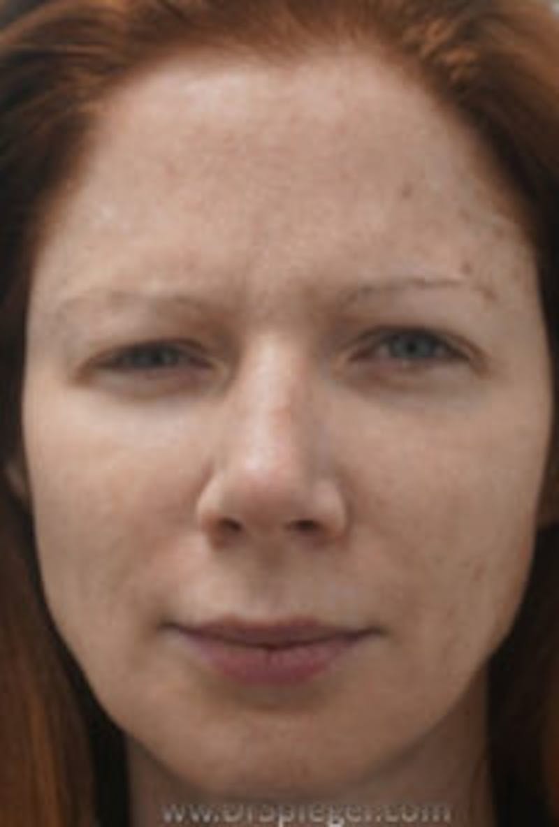 Botox / Dysport / Jeuveau / Xeomin Before & After Gallery - Patient 197717 - Image 1