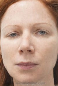 Botox / Dysport / Jeuveau / Xeomin Before & After Gallery - Patient 197717 - Image 2